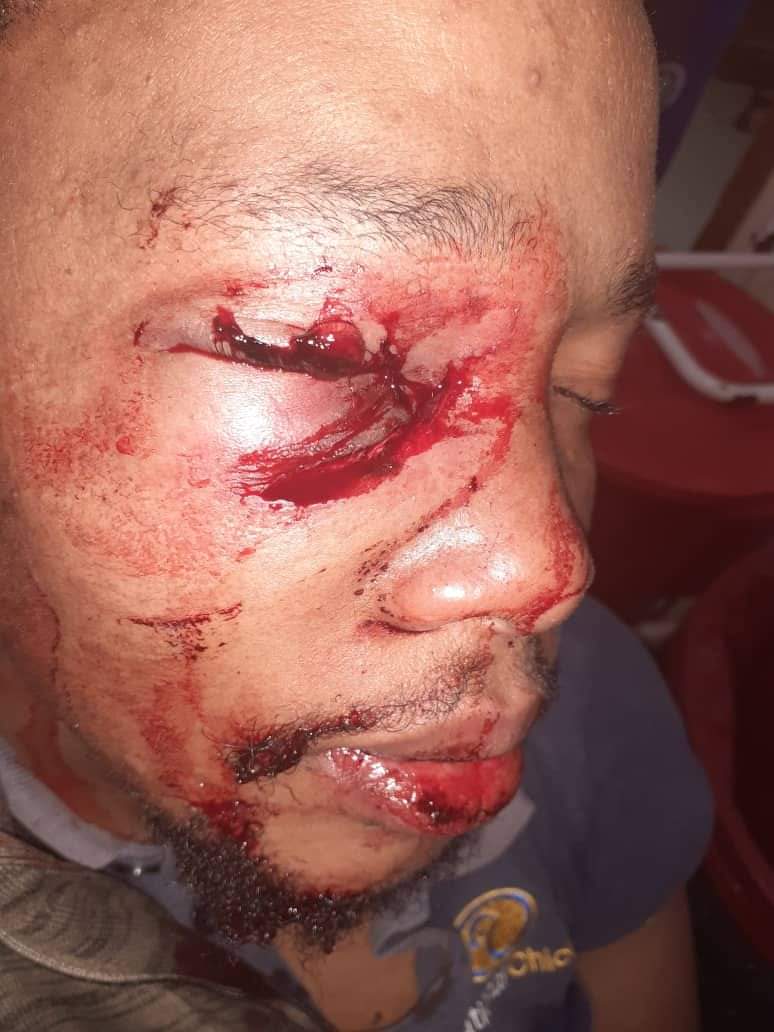 FAMILY SPEAKS: Phiwayinkosi Dlamini who was shot in the eye by royal police undergoing operation.